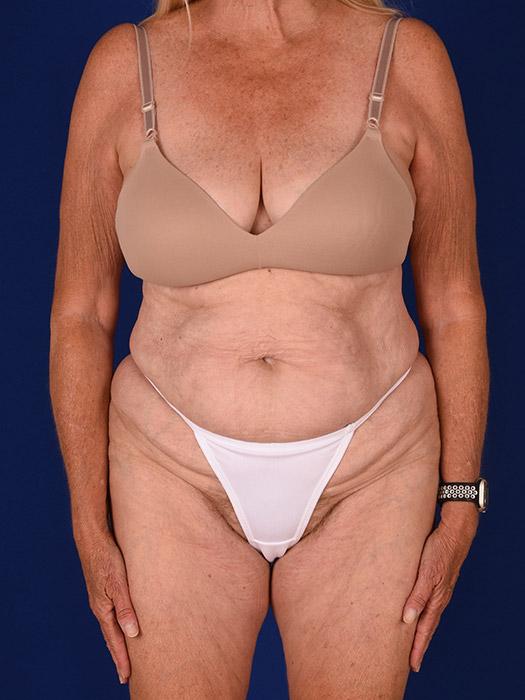 Shapiro Plastic Surgery mommy makeover after — Scottsdale, AZ