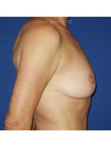 Breast Lift before at Shapiro Plastic Surgery in Scottsdale, AZ