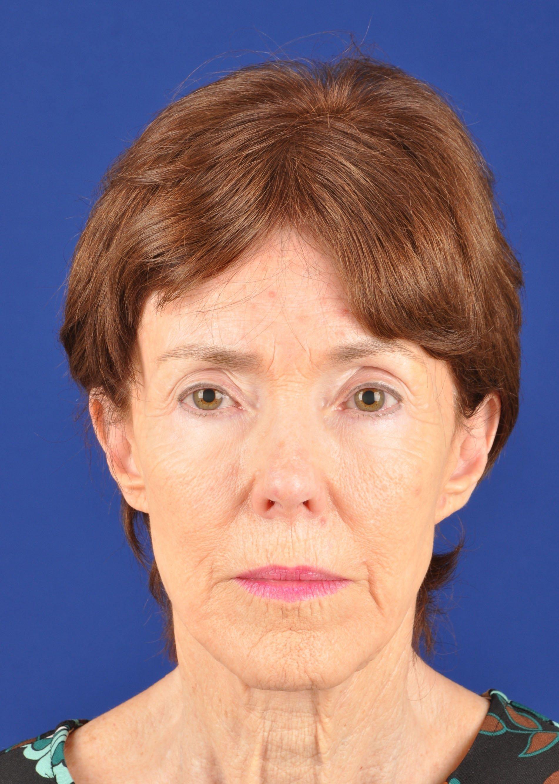 Shapiro Plastic Surgery facelift after — Scottsdale, AZ