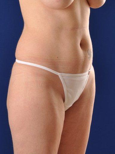 Shapiro Plastic Surgery liposuction after — Scottsdale, AZ