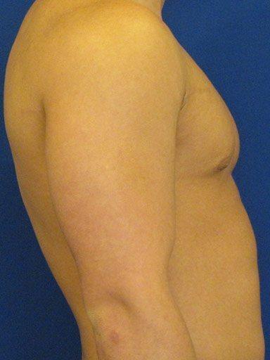 Gynecomastia Surgery after at Shapiro Plastic Surgery in Scottsdale, AZ