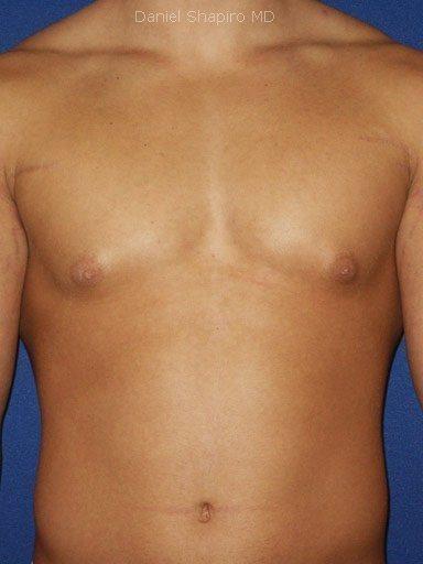 Gynecomastia Surgery before at Shapiro Plastic Surgery in Scottsdale, AZ