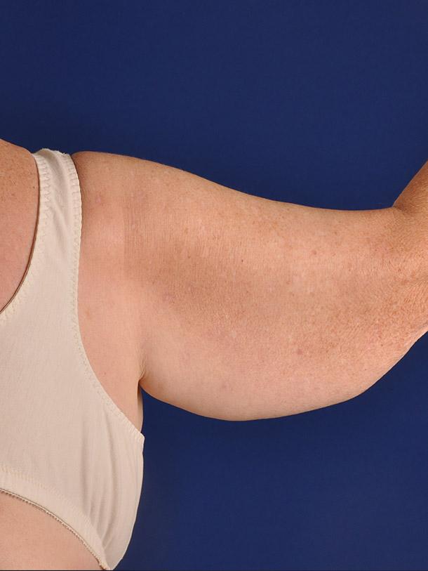 Arm Lift after at Shapiro Plastic Surgery in Scottsdale, AZ