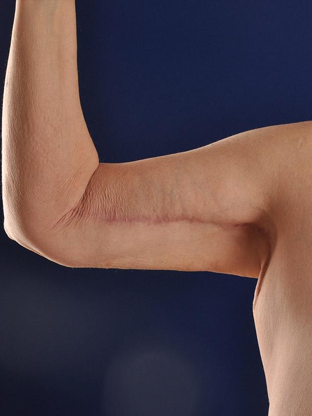 Arm Lift before at Shapiro Plastic Surgery in Scottsdale, AZ