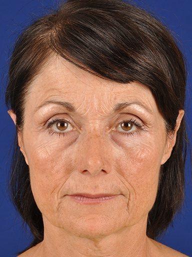 Shapiro Plastic Surgery facelift after — Scottsdale, AZ