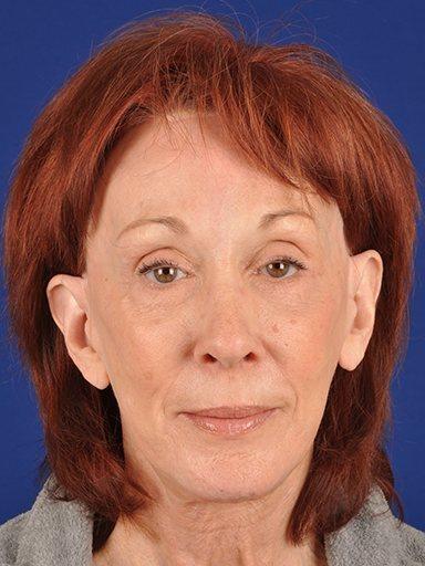Shapiro Plastic Surgery facelift after — Scottsdale, AZ