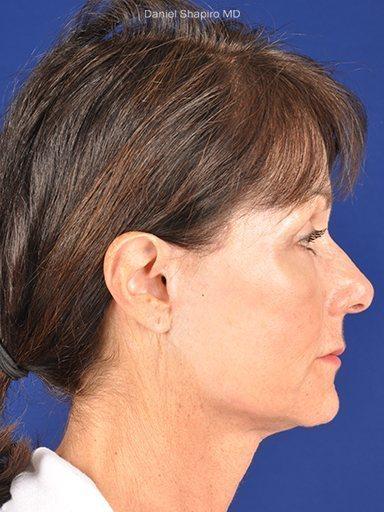 Mini Facelift before at Shapiro Plastic Surgery in Scottsdale, AZ