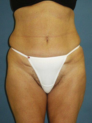 Shapiro Plastic Surgery liposuction after — Scottsdale, AZ