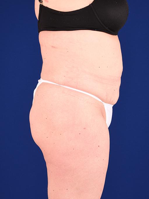 Shapiro Plastic Surgery tummy tuck after — Scottsdale, AZ