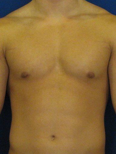 Gynecomastia Surgery after at Shapiro Plastic Surgery in Scottsdale, AZ