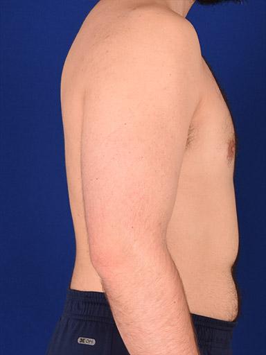Gynecomastia Surgery before at Shapiro Plastic Surgery in Scottsdale, AZ
