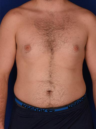 Gynecomastia Surgery after at Shapiro Plastic Surgery in Scottsdale, AZ