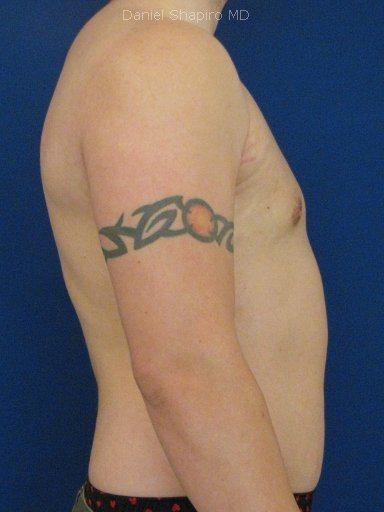 Gynecomastia Surgery before at Shapiro Plastic Surgery in Scottsdale, AZ