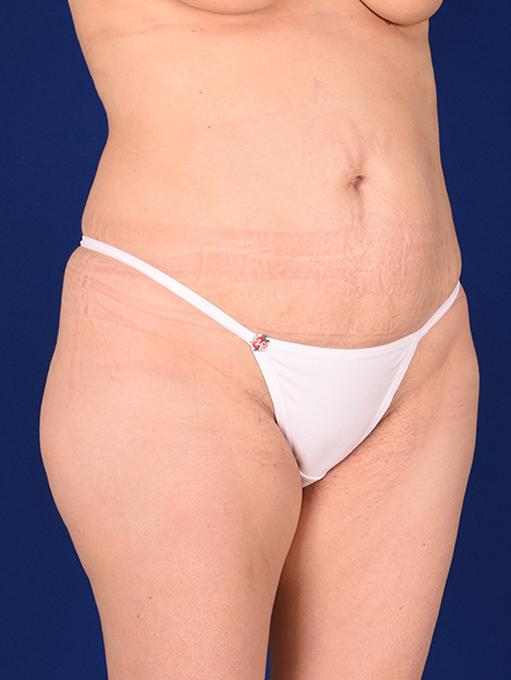 Shapiro Plastic Surgery tummy tuck after — Scottsdale, AZ