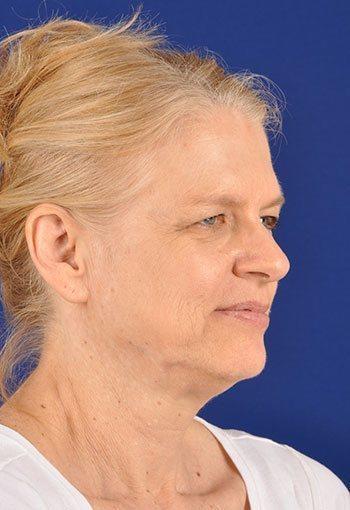 Shapiro Plastic Surgery blepharoplasty after — Scottsdale, AZ