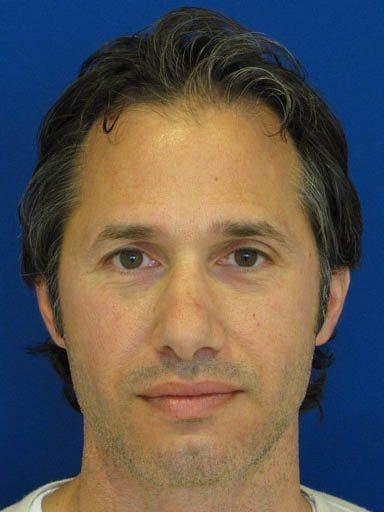Shapiro Plastic Surgery rhinoplasty after — Scottsdale, AZ