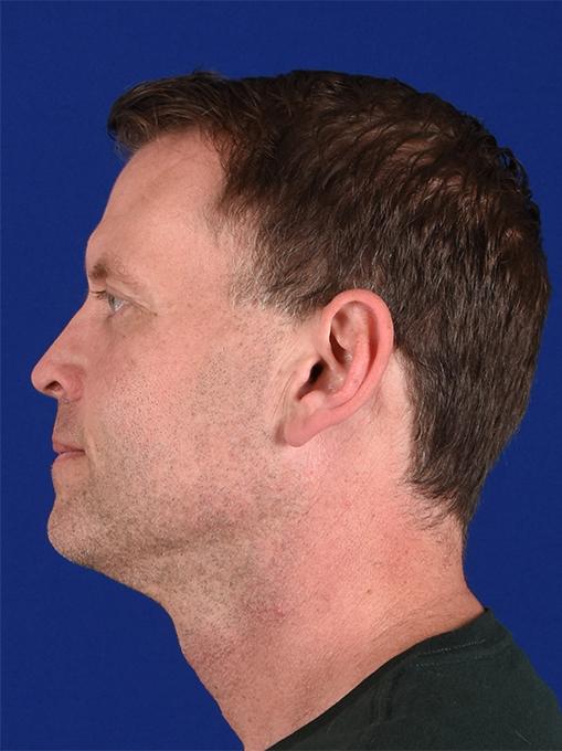 Rhinoplasty before at Shapiro Plastic Surgery in Scottsdale, AZ