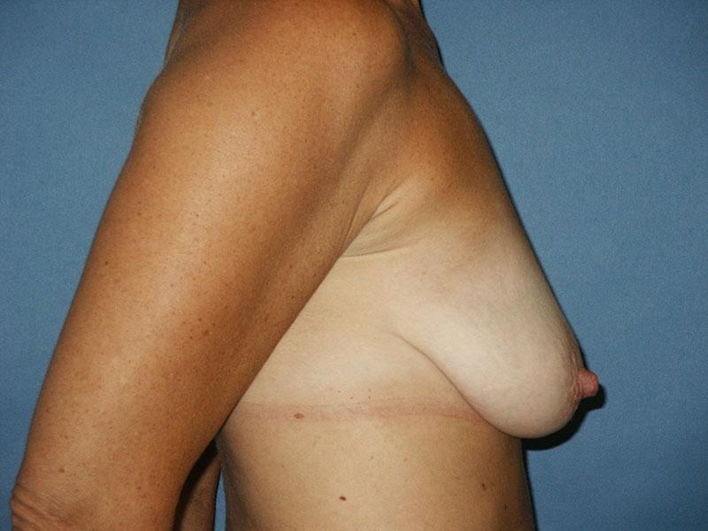 Shapiro Plastic Surgery breast augmentation after — Scottsdale, AZ