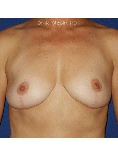 Breast Lift before at Shapiro Plastic Surgery in Scottsdale, AZ
