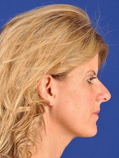 Shapiro Plastic Surgery facelift after — Scottsdale, AZ