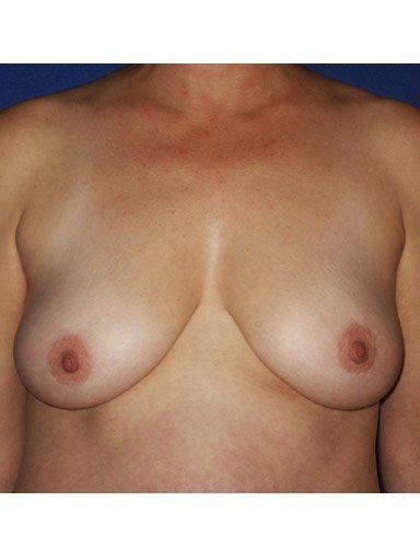Breast Lift after at Shapiro Plastic Surgery in Scottsdale, AZ