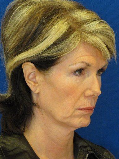 Shapiro Plastic Surgery fat transfer after — Scottsdale, AZ