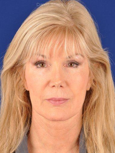 Fat Transfer before at Shapiro Plastic Surgery in Scottsdale, AZ
