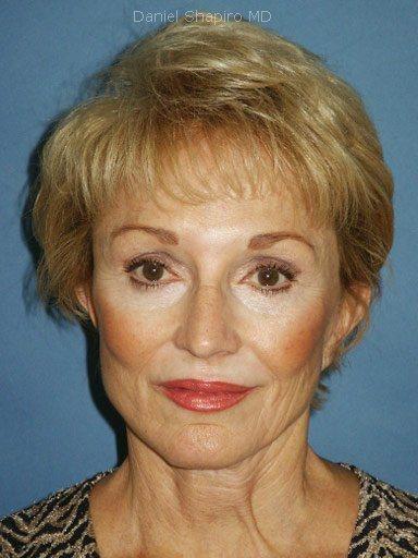 Chin Implant before at Shapiro Plastic Surgery in Scottsdale, AZ