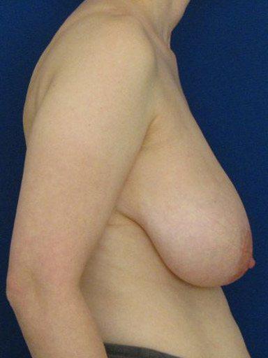 Breast Reduction after at Shapiro Plastic Surgery in Scottsdale, AZ