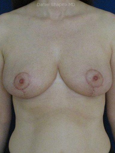 Breast Reduction before at Shapiro Plastic Surgery in Scottsdale, AZ