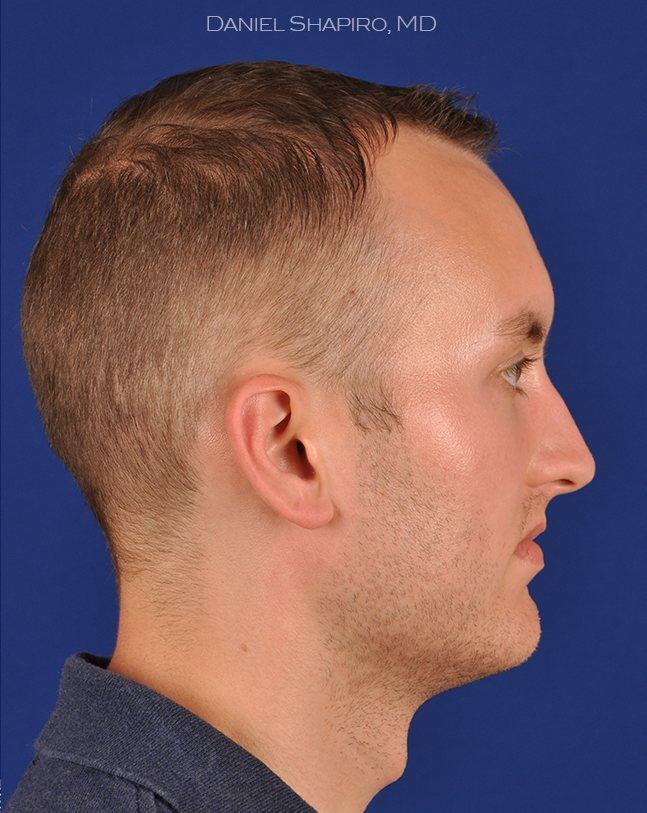 Shapiro Plastic Surgery rhinoplasty after — Scottsdale, AZ