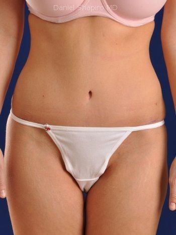 Tummy Tuck before at Shapiro Plastic Surgery in Scottsdale, AZ