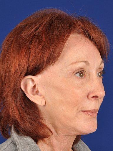 Shapiro Plastic Surgery facelift after — Scottsdale, AZ