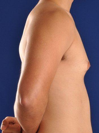 Gynecomastia Surgery after at Shapiro Plastic Surgery in Scottsdale, AZ