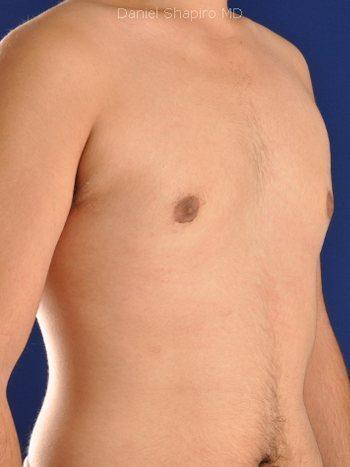 Gynecomastia Surgery before at Shapiro Plastic Surgery in Scottsdale, AZ