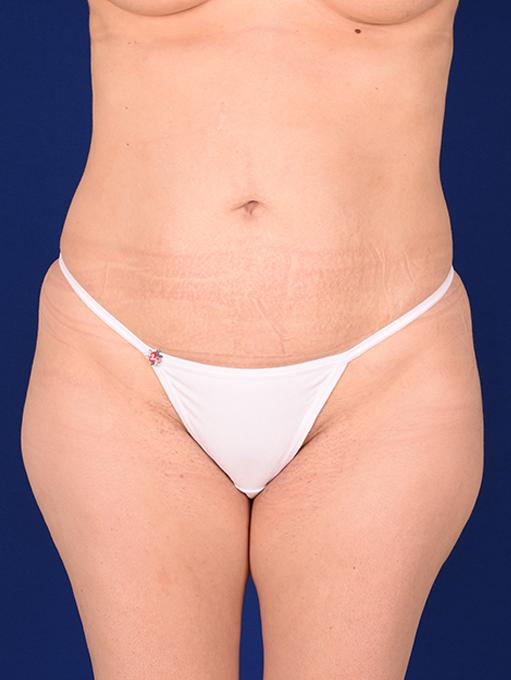 Shapiro Plastic Surgery tummy tuck after — Scottsdale, AZ