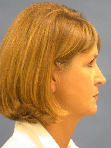Chin Implant after at Shapiro Plastic Surgery in Scottsdale, AZ