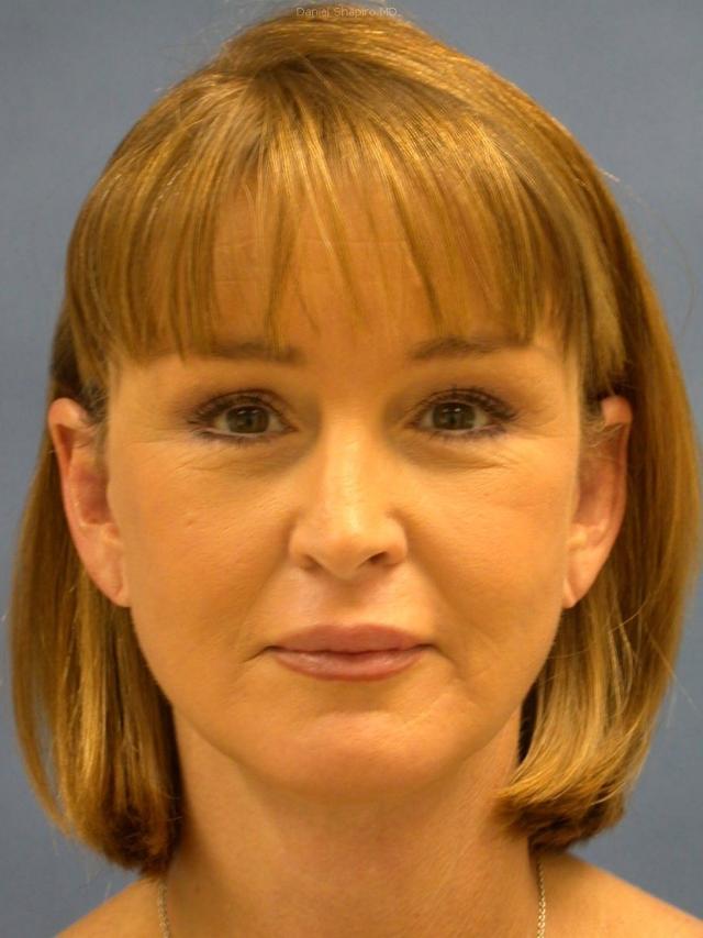 Chin Implant before at Shapiro Plastic Surgery in Scottsdale, AZ