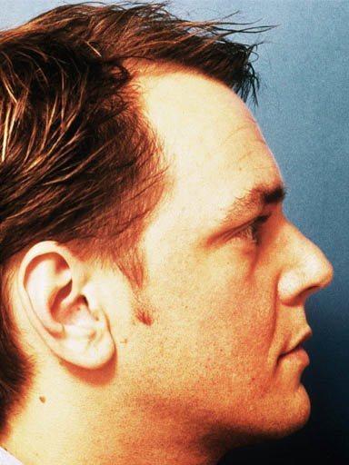 Shapiro Plastic Surgery rhinoplasty after — Scottsdale, AZ