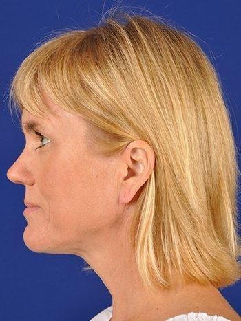 Fat Transfer after at Shapiro Plastic Surgery in Scottsdale, AZ
