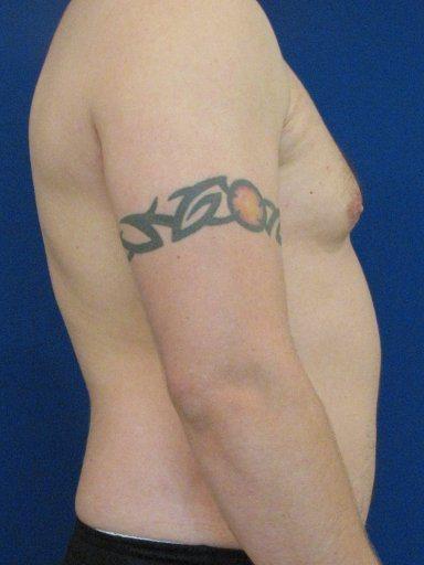 Gynecomastia Surgery after at Shapiro Plastic Surgery in Scottsdale, AZ