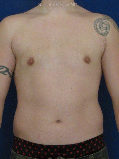 Gynecomastia Surgery before at Shapiro Plastic Surgery in Scottsdale, AZ