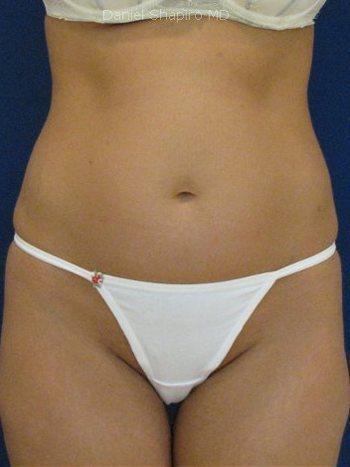 Shapiro Plastic Surgery tummy tuck after — Scottsdale, AZ