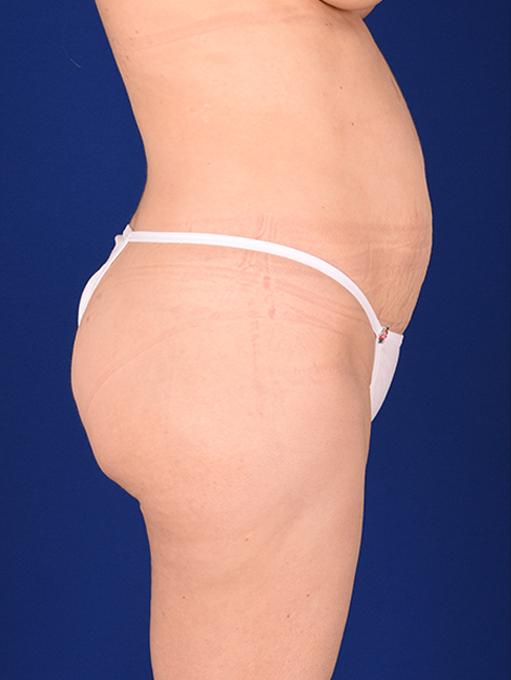 Shapiro Plastic Surgery tummy tuck after — Scottsdale, AZ