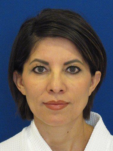 Shapiro Plastic Surgery blepharoplasty after — Scottsdale, AZ