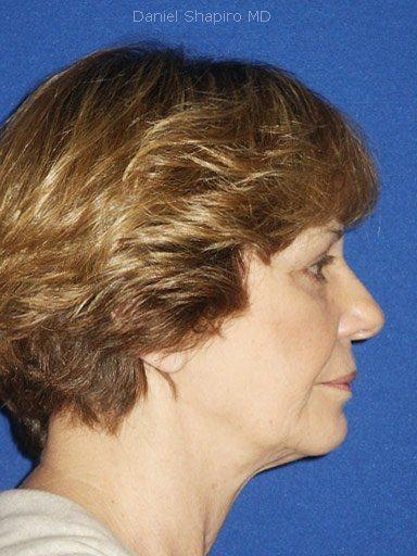 Blepharoplasty before at Shapiro Plastic Surgery in Scottsdale, AZ