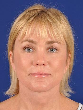 Fat Transfer before at Shapiro Plastic Surgery in Scottsdale, AZ