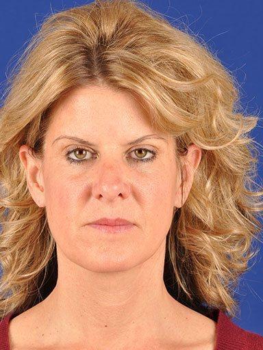 Shapiro Plastic Surgery facelift after — Scottsdale, AZ
