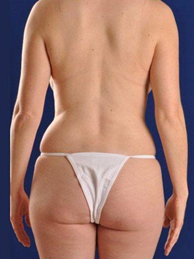 Shapiro Plastic Surgery bbl after — Scottsdale, AZ