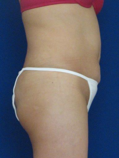 Shapiro Plastic Surgery bbl after — Scottsdale, AZ